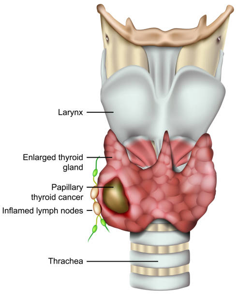 nodulo na tireoide
