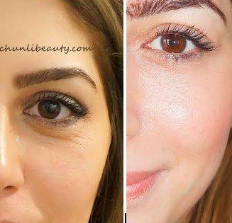 Under Eye Light Filling Comments Side Effects And Before After Images Newlyme