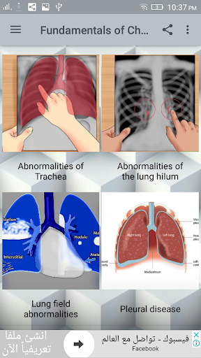 Chest X-Ray Interpretation