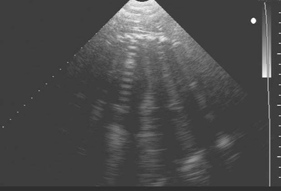 Imagen ecográfica transabdominal del torax fetal obtenida con un transductor sectorial de 2,5 MHz. Las sombras son producidas por las vértebras y las costillas. El plano ventral es la parte superior de la imagen y el plano dorsal la inferior.