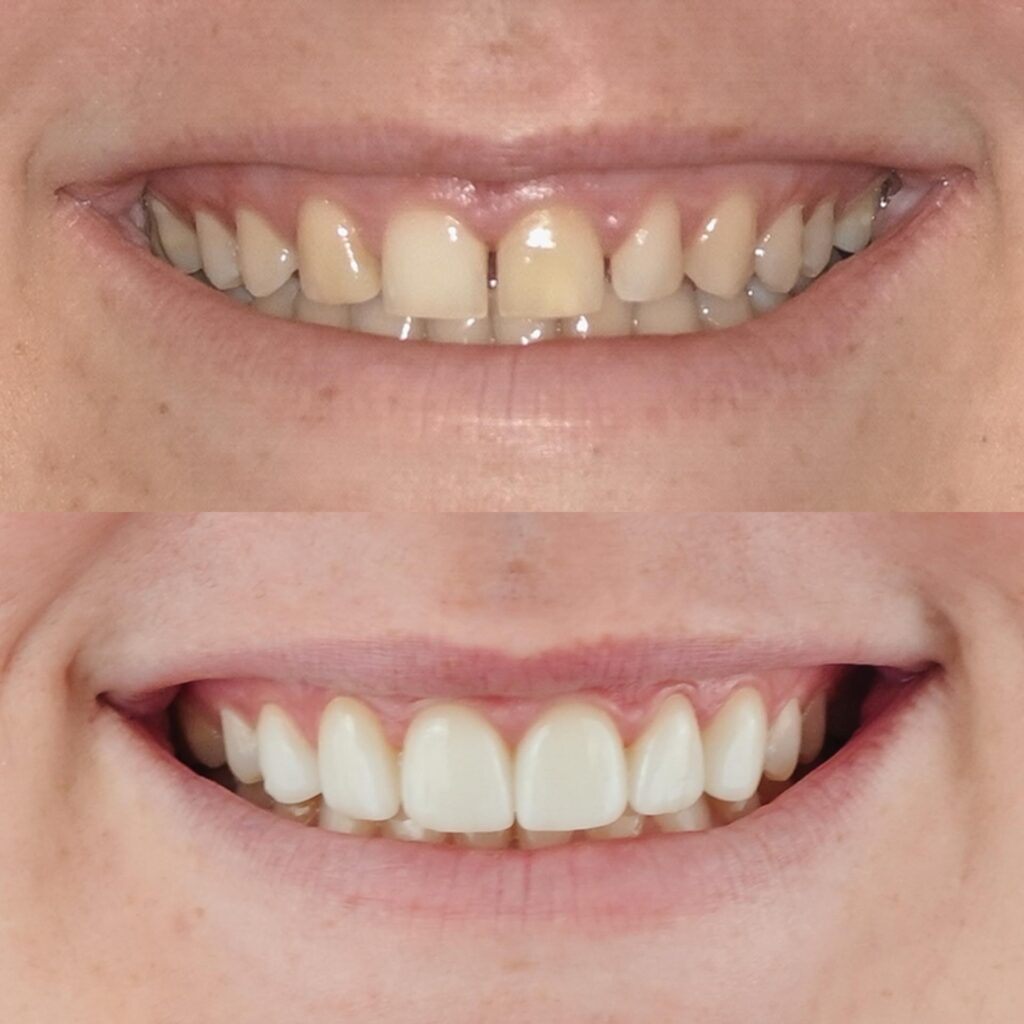 Veneer Case Teeth