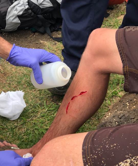 The bite marks left by the shark on Dylan McWilliams's leg.