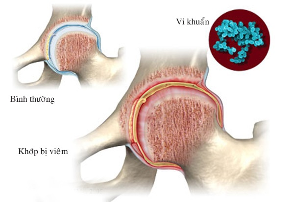 Nhiễm khuẩn là một trong những nguyên nhân chính gây viêm khớp phổ biến