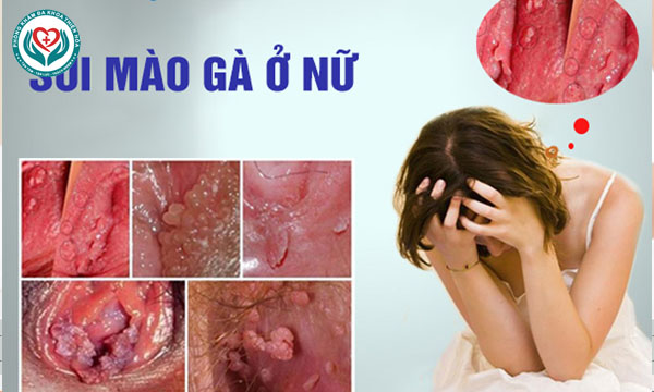 sùi mào ở nữ giới