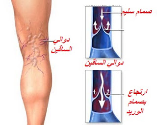 دوالي الساقين