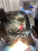 The head injury sustained by Mitchel Walls.