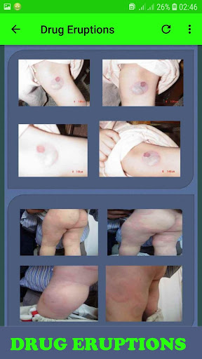 All Skin Infections  Treatments - Diseases Atlas