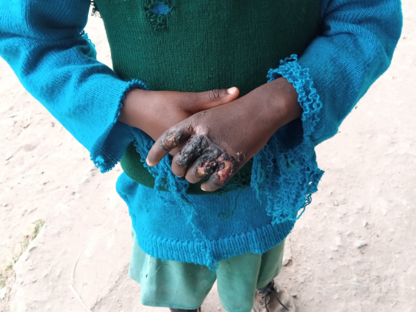 One of the girls whose hands were burnt by their mother for licking sugar in Athi River, Machakos County on Wednesday, July 20.