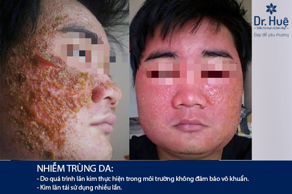 Làn da bị nhiễm trùng