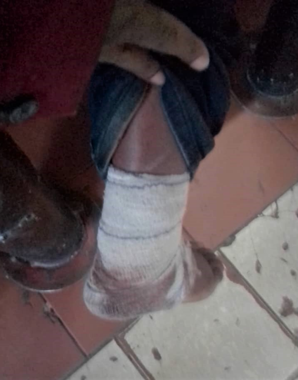 Mbeketeli Fakudze examines his bandaged ankle after allegedly being shot with a rubber bullet.