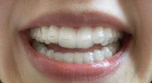 nvisalign braces Singapore