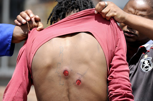 One of the protesters with rubber bullet wounds on January 30, 2014 in Bronkhorstspruit, South Africa. Residents marched to the City of Tshwane municipal offices to hand the mayor, Kgosientso Ramokgopa, a memorandum of their grievances. They failed to meet the mayor as the municipal offices were closed. Protesters started throwing bricks at police officers who then retaliated with rubber bullets.