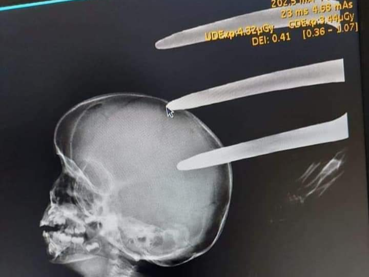 X-ray image of the fork jembe lodged in the boy's head.