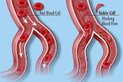 Normal blood cells, left, and the blood cells in sickle cell disease, which do not flow smoothly through the circulatory system. 