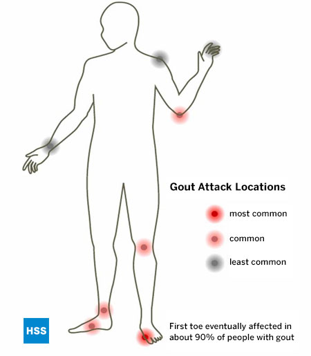 Most common gout attack locations according to Dr. Theodore R. Fields, MD, FACP