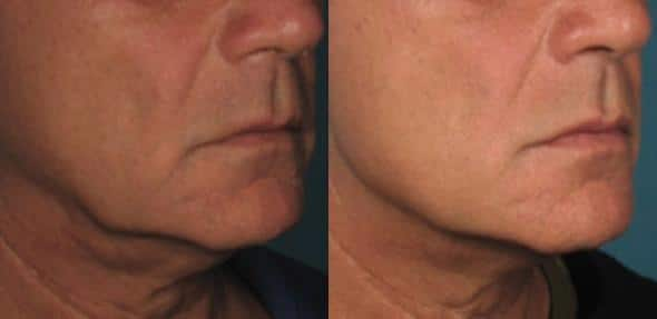 reverse aging procedures new york