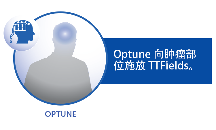 Optune® 如何将 TTFields 传递到肿瘤部位