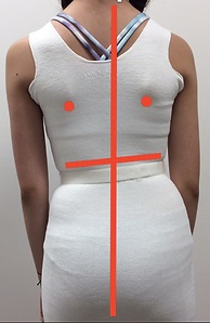 Scoliosis is a 3-Dimensional Condition