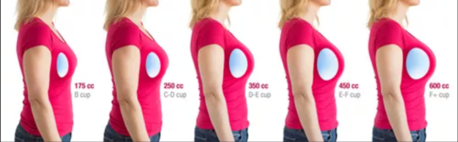 Breast Implant Sizes Chart