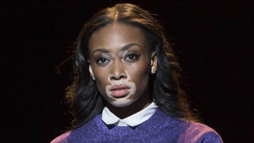 Chantelle Brown-Young, aka Winnie Harlow, is a Canadian beauty with vitiligo, which causes depigmentation to parts of the skin.