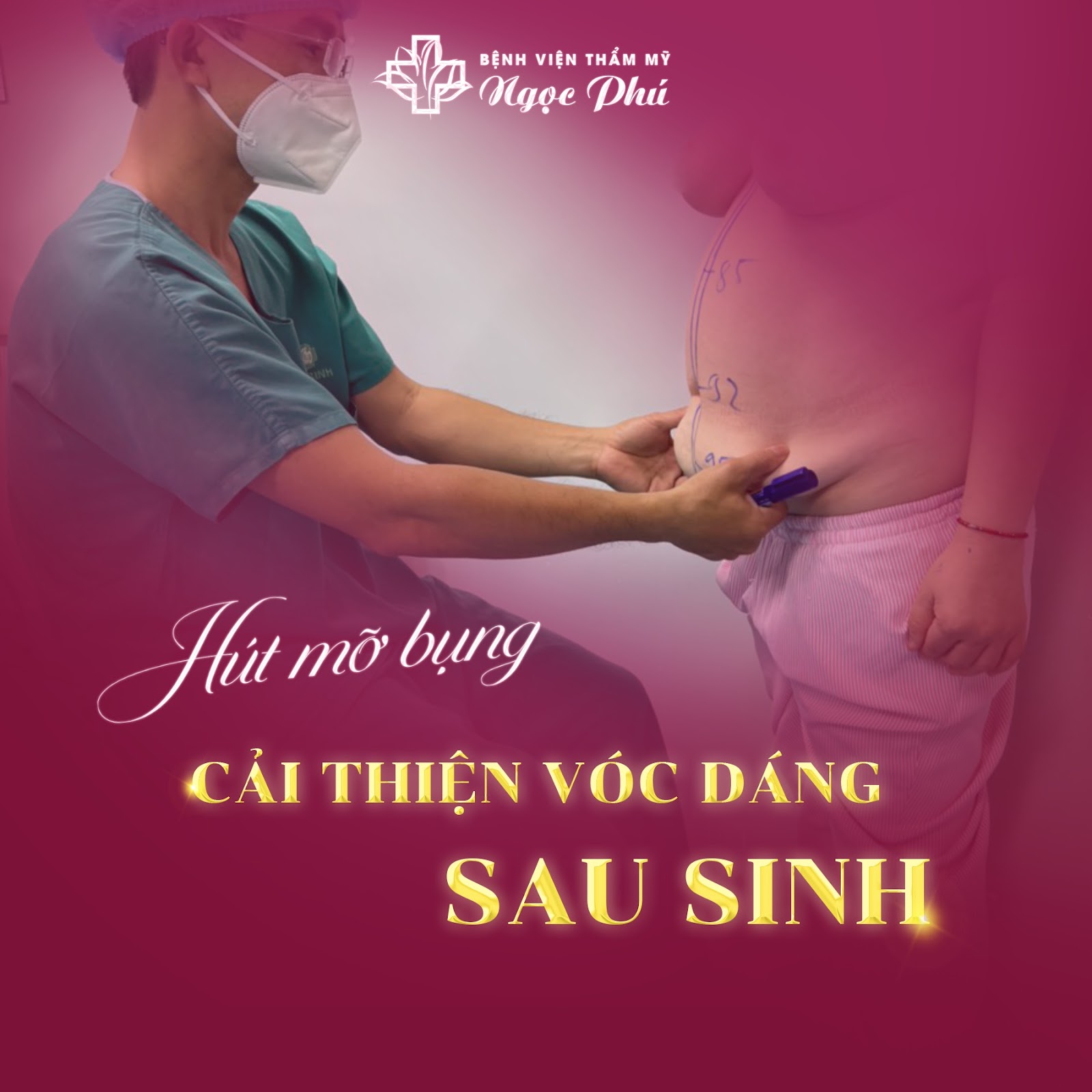Hút mỡ tạo hình thành bụng tại Thẩm mỹ Thẩm Mỹ Việt Nam đang là dịch vụ được đông đảo khách hàng quan tâm