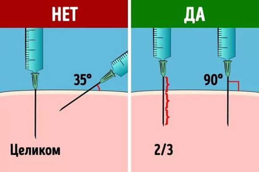 Как делать укол внутримышечно в ягодицу. Как правильно делать уколы внутримышечно в ягодицу. Как правильно делать уколы внутримышечно в ягодицу домашних условиях. Как колоть внутримышечные уколы в ягодицу.