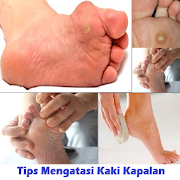 Tips to Overcome Foot Calluses  Icon