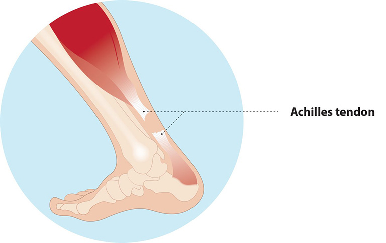 Vị trí của gân Achilles ở cổ chân