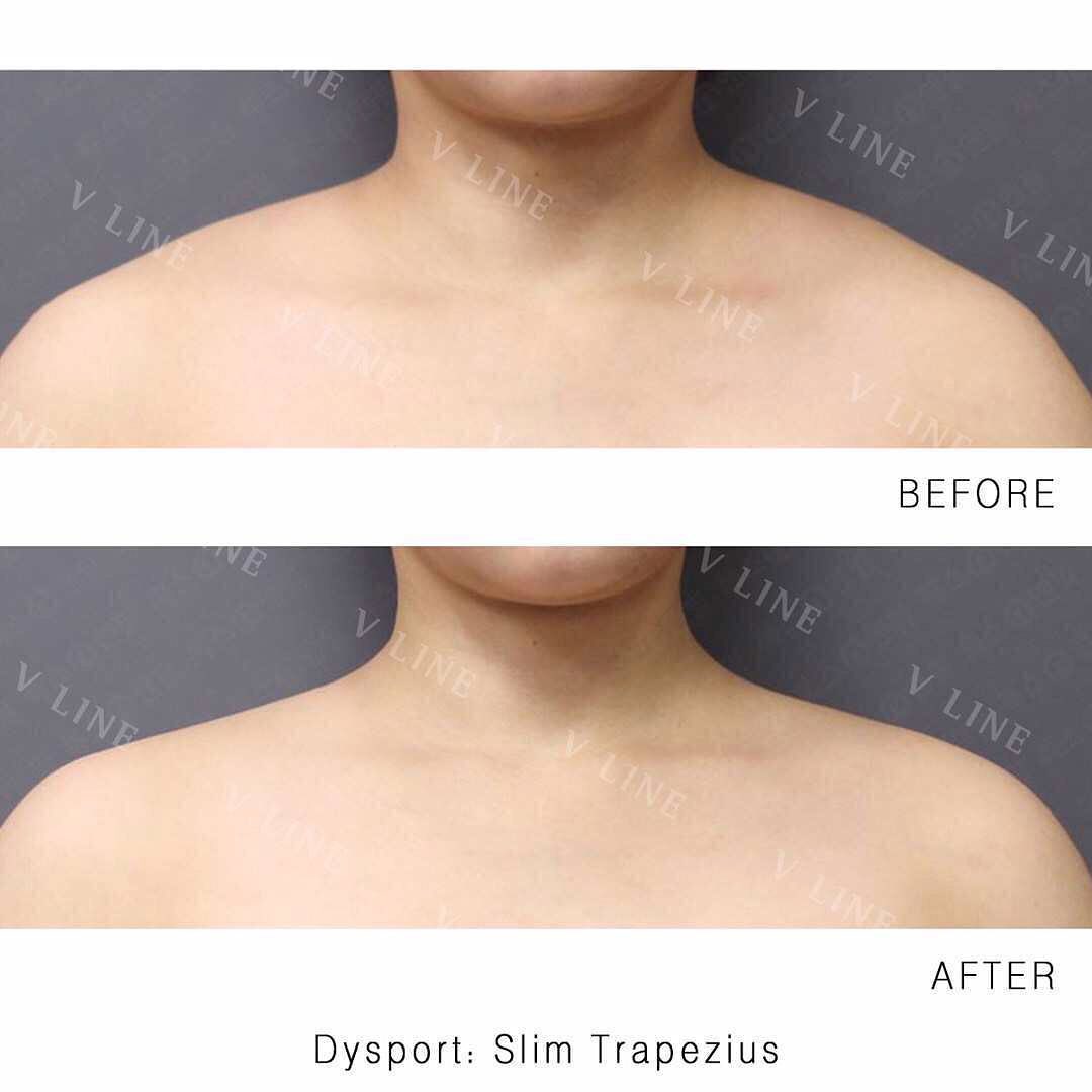 Dysport before and after results of shoulder slimming – Dysport shoulder slimming results