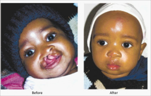 HAPPIER: An example of what can be achieved by reconstructive facial surgery. © Unknown.