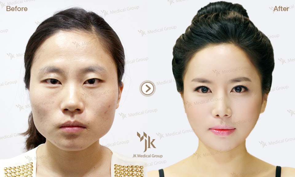 9 Most Popular Plastic Surgery Procedures In Korea Koreaboo 