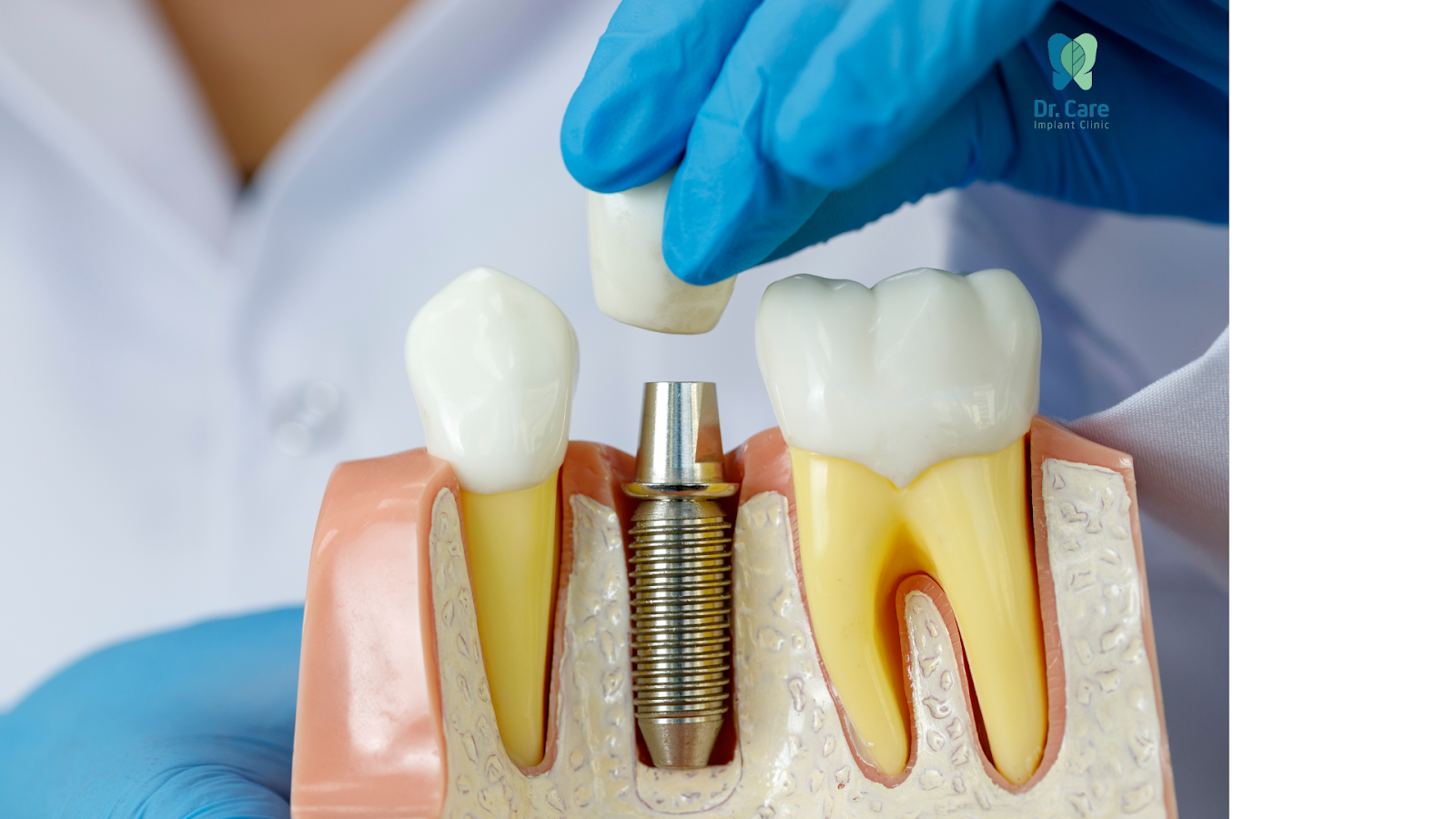 Giải pháp trồng răng Implant