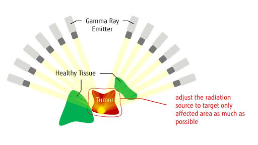 Fig.1 Overview of Gamma Knife Therapy