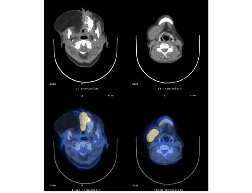 Adenoid cystic carcinoma