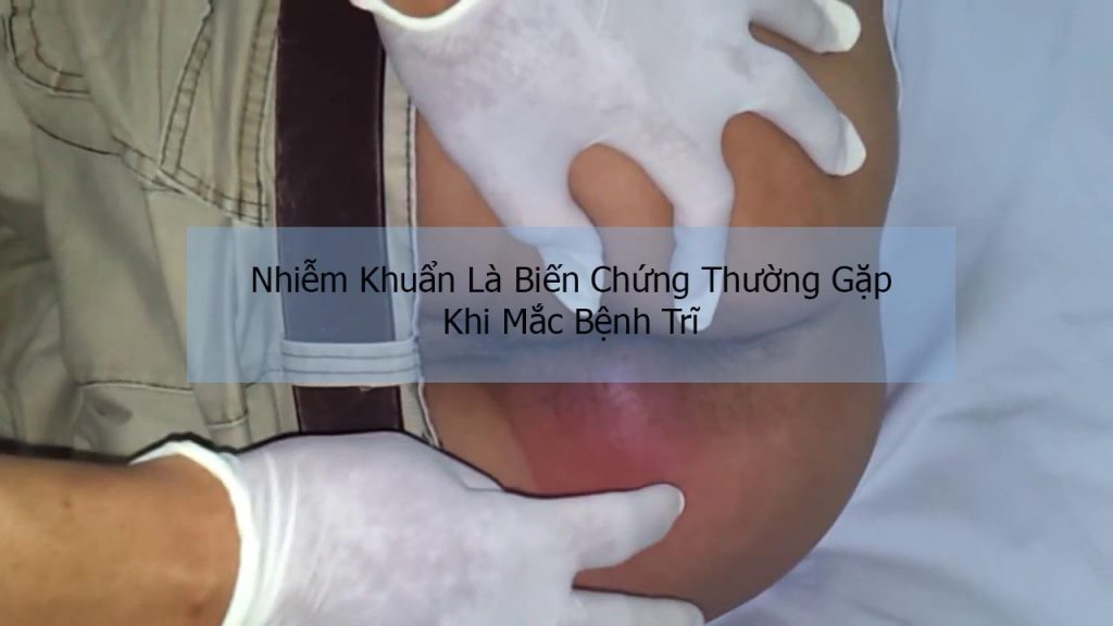 biến chứng khi mắc bệnh trĩ