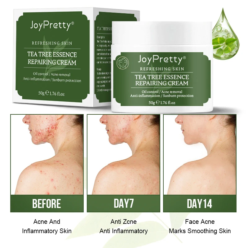 Tea Tree Olie Anti-Acne Hydraterende Crème. Verwijdert Acne en Hydrateert. Helpt tegen Puistjes en Vlekken. Voor Een Schone en Gezonde Huid.