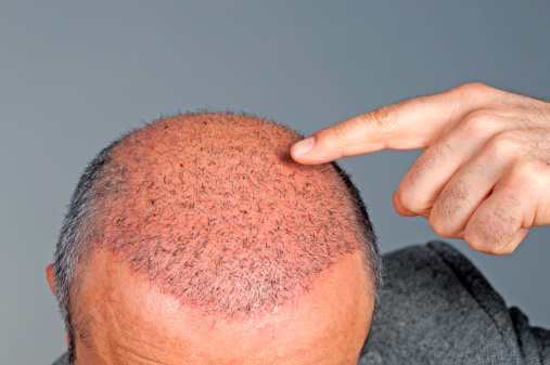 Hair Transplant Treatment in Delhi