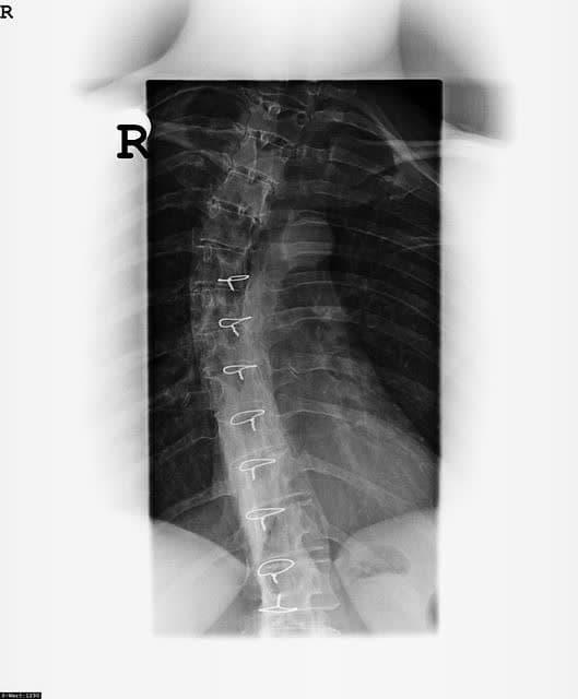 انحراف ستون فقرات چیست ؟
( Scoliosis ) اسکولیز