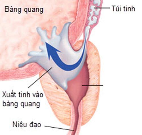 Xuất tinh ngược dòng là gì: nguyên nhân, cách chữa • Chao Bacsi