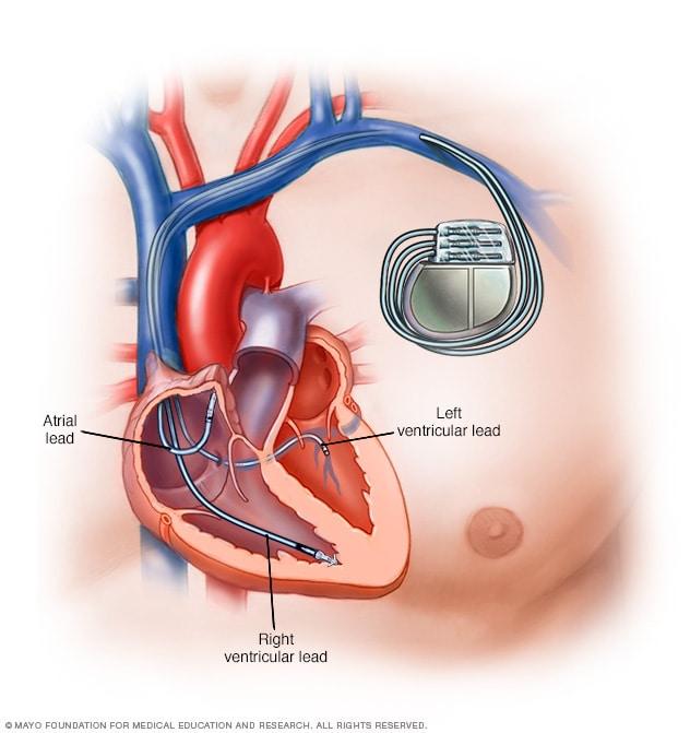 Máy tạo nhịp tim