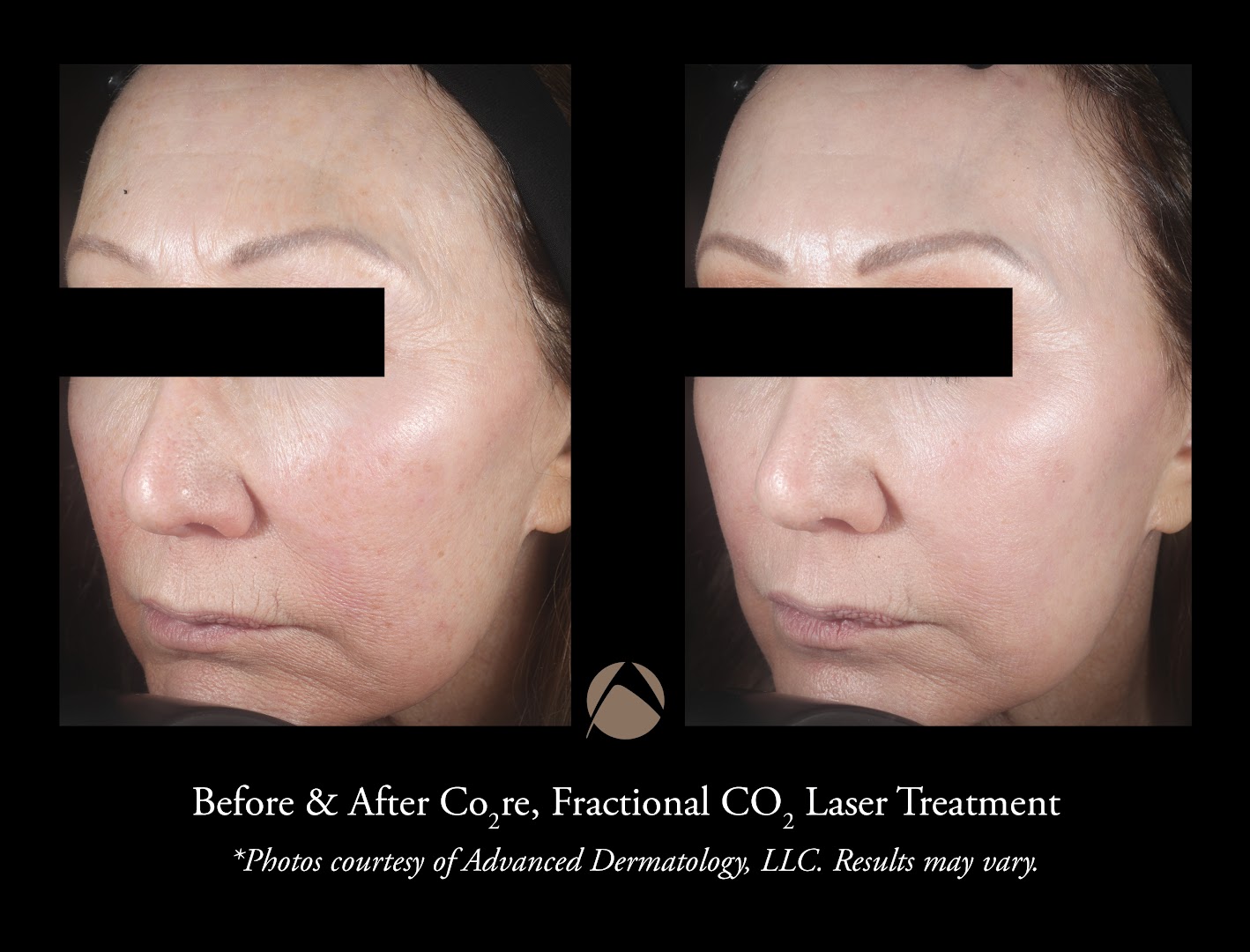 Fractional CO2 Laser Before and After Photos