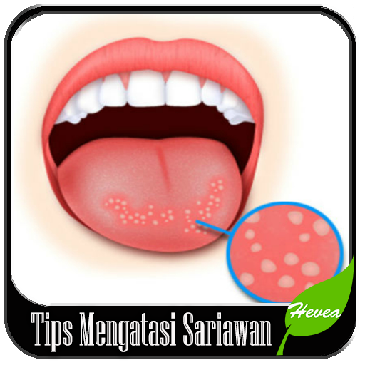 Tips Mengatasi Sariawan