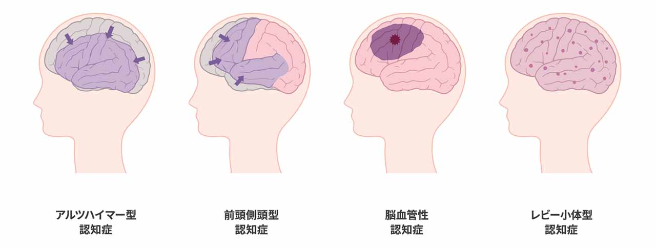 若年性認知症の主な種類と症状