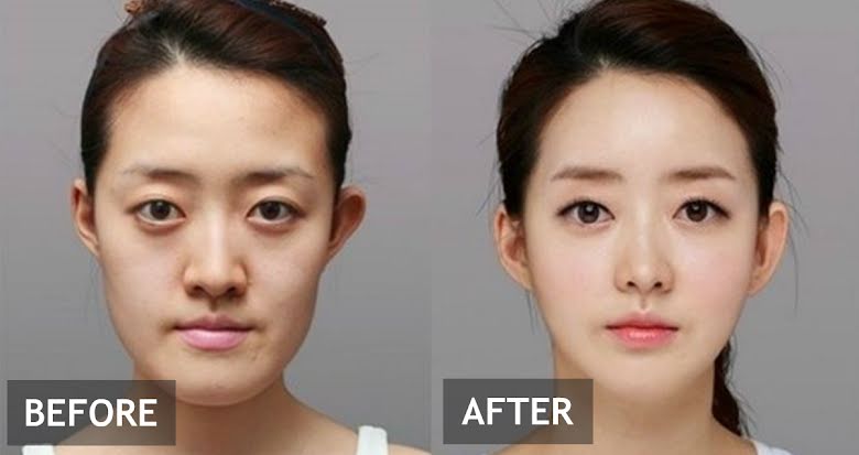 Weniger Plastic Surgery