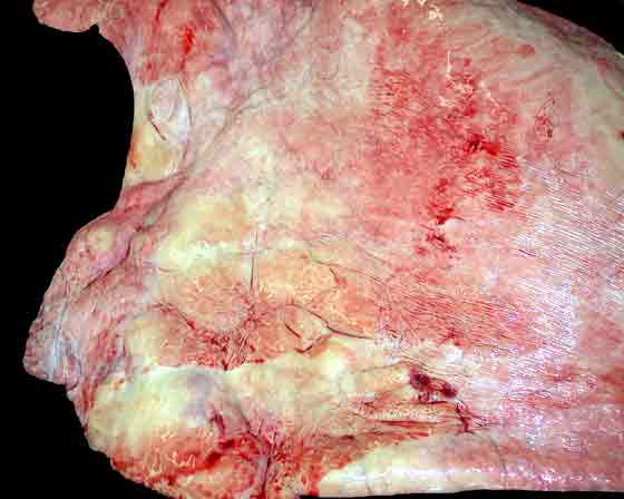 Same condition as in Figure 35, illustrating distorted abnormal bronchi and surrounding areas of lung collapse.