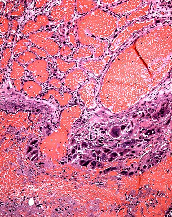 Base of the placenta with multinucleated giant cells