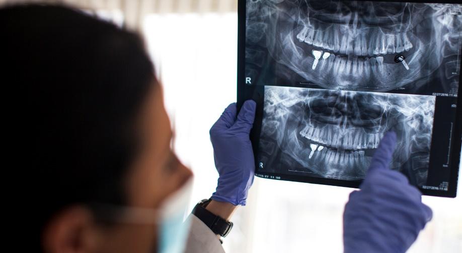 3 consecuencias graves de no hacerse implantes dentales