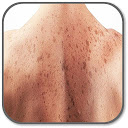 Herunterladen How To Prevent Skin Cancer Installieren Sie Neueste APK Downloader