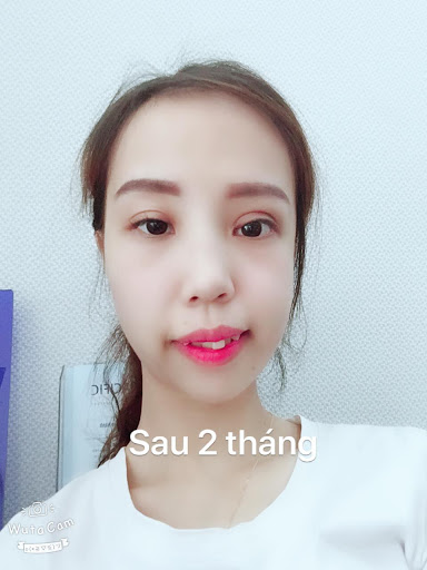 Gương mặt thay đổi đáng kể của Xuân Thương sau 2 tháng phẫu thuật