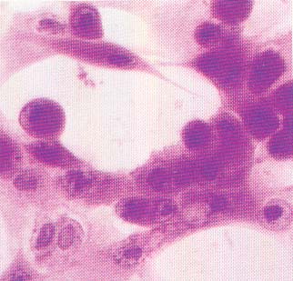 Inclusiones intranucleares por Herpesvirus equino "lento". Cortesía de A. Wayne Roberts.